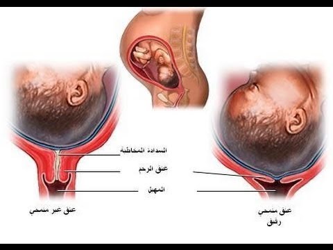 كيف اعرف ان الرحم فاتح , علامات الرحم المفتوح