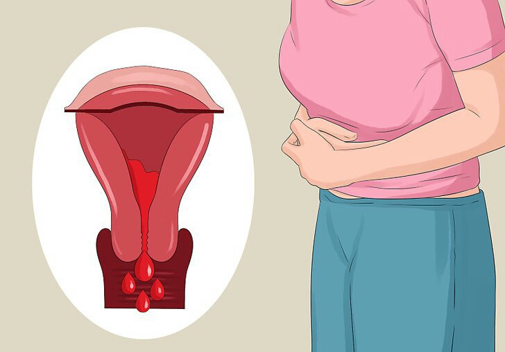 كيف نوقف نزيف الدورة الشهرية , ايقاف غزارة الطمث