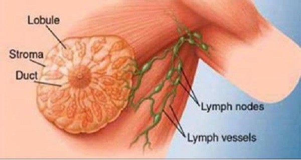 هل سرطان الثدي يؤلم - اعراض سرطان الثدى للسيدات هل سرطان الثدي يؤلم اعراض سرطان الثدى