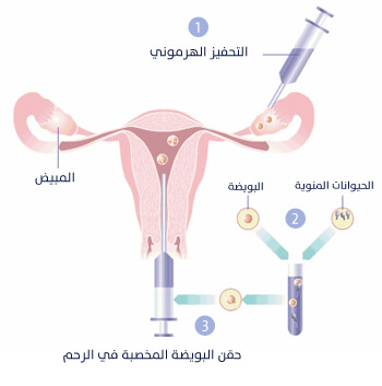 عمليه اطفال الانابيب بقطر ونجاحه-عمليات اطفال الانابيب و تفاصيلها -D8-A7-D8-B7-D9-81-D8-A7-D9-84 -D8-A7-D9-84-D8-A7-D9-86-D8-A7-D8-A8-D9-8A-D8-A8 1