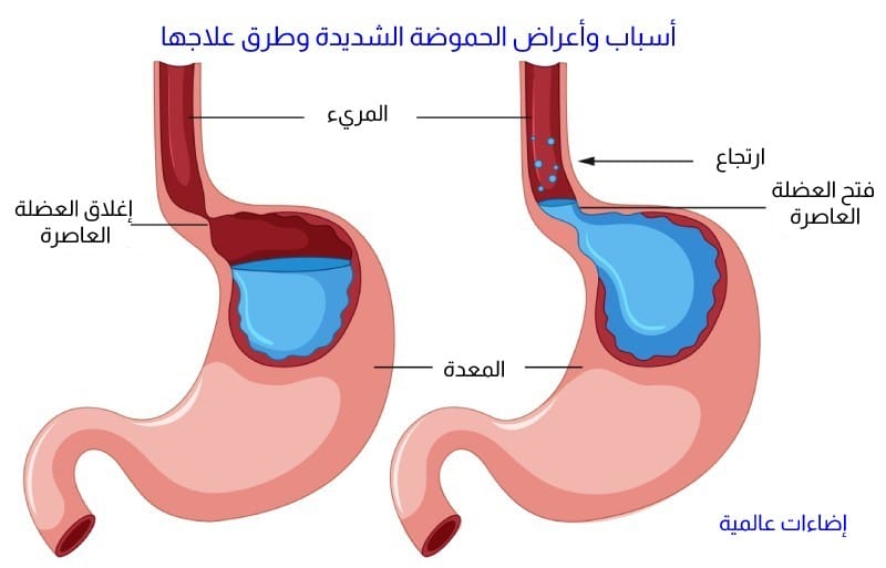 اعراض حموضة المعده الشديده-المعاناه مع المعده والقولون مزمن -D8-A7-D8-B9-D8-B1-D8-A7-D8-B6 -D8-Ad-D9-85-D9-88-D8-B6-D8-A9 -D8-A7-D9-84-D9-85-D8-B9-D8-Af-D9-87 -D8-A7-D9-84-D8-B4-D8-Af-D9-8A-D8-Af-D9-87-D8-A7-D9-84-D9-85-D8-B9-D8-A7-D9-86-D8-A7-D9-87 -D9-85