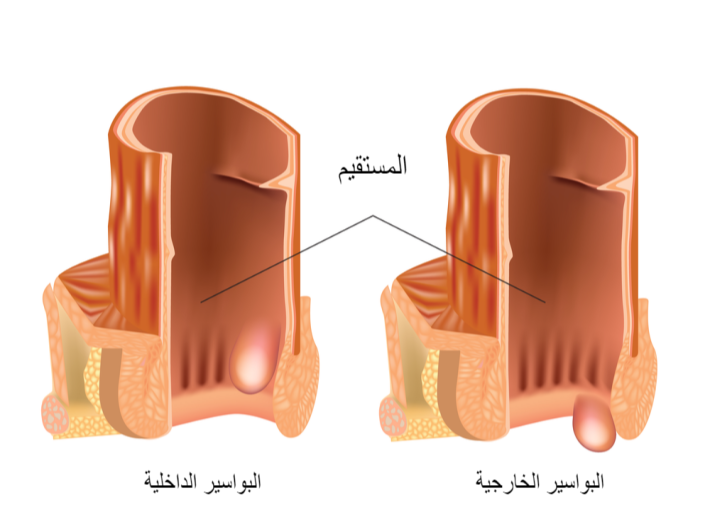 شكل البواسير الخارجية بالصور الحقيقية-أشكال البواسير بالصور -D8-B4-D9-83-D9-84 -D8-A7-D9-84-D8-A8-D9-88-D8-A7-D8-B3-D9-8A-D8-B1 -D8-A7-D9-84-D8-Ae-D8-A7-D8-B1-D8-Ac-D9-8A-D8-A9 -D8-A8-D8-A7-D9-84-D8-B5-D9-88-D8-B1 -D8-A7-D9-84-D8-Ad-D9-82-D9-8A-D9-82-D9-8A 1