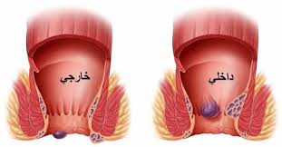 شكل البواسير الخارجية بالصور الحقيقية-أشكال البواسير بالصور -D8-B4-D9-83-D9-84 -D8-A7-D9-84-D8-A8-D9-88-D8-A7-D8-B3-D9-8A-D8-B1 -D8-A7-D9-84-D8-Ae-D8-A7-D8-B1-D8-Ac-D9-8A-D8-A9 -D8-A8-D8-A7-D9-84-D8-B5-D9-88-D8-B1 -D8-A7-D9-84-D8-Ad-D9-82-D9-8A-D9-82-D9-8A 5