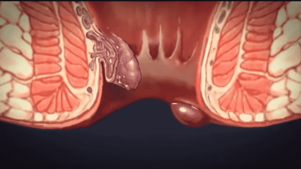 شكل البواسير الخارجية بالصور الحقيقية-أشكال البواسير بالصور -D8-B4-D9-83-D9-84 -D8-A7-D9-84-D8-A8-D9-88-D8-A7-D8-B3-D9-8A-D8-B1 -D8-A7-D9-84-D8-Ae-D8-A7-D8-B1-D8-Ac-D9-8A-D8-A9 -D8-A8-D8-A7-D9-84-D8-B5-D9-88-D8-B1 -D8-A7-D9-84-D8-Ad-D9-82-D9-8A-D9-82-D9-8A
