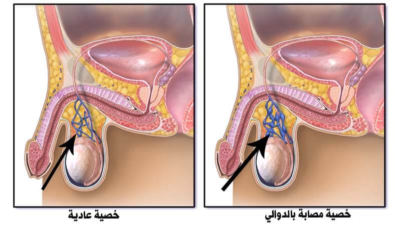 علاج طبيعي لدوالي الخصية- لا حياء في العلم لا تخف -D8-B9-D9-84-D8-A7-D8-Ac -D8-B7-D8-A8-D9-8A-D8-B9-D9-8A -D9-84-D8-Af-D9-88-D8-A7-D9-84-D9-8A -D8-A7-D9-84-D8-Ae-D8-B5-D9-8A-D8-A9 -D9-84-D8-A7 -D8-Ad-D9-8A-D8-A7-D8-A1 -D9-81-D9-8A -D8-A7-D9-84-D8-B9