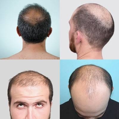 زراعة الشعر بطريقة dhi , مميزات زراعه الشعر بطريقة dhi