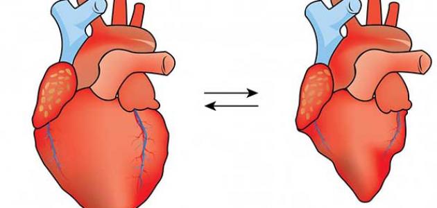 اعراض ارتخاء صمام القلب- ما هو مرض ارتخاء صمام القلب اعراض ارتخاء صمام القلب ما هو مرض ارتخا