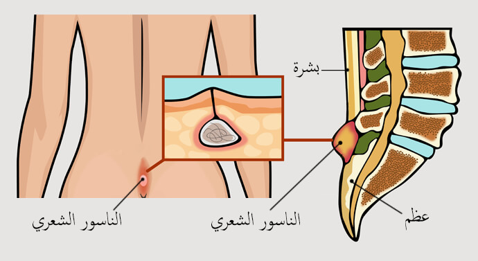 بواسير ناسور دمامل مادري وش بالضبط , الفرق بين امراض المسالك البوليه