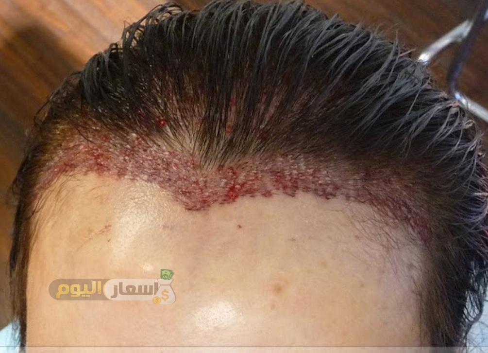 تكلفة زراعة الشعر في مصر 2024 , تكاليف عمليه التجميل في مصر