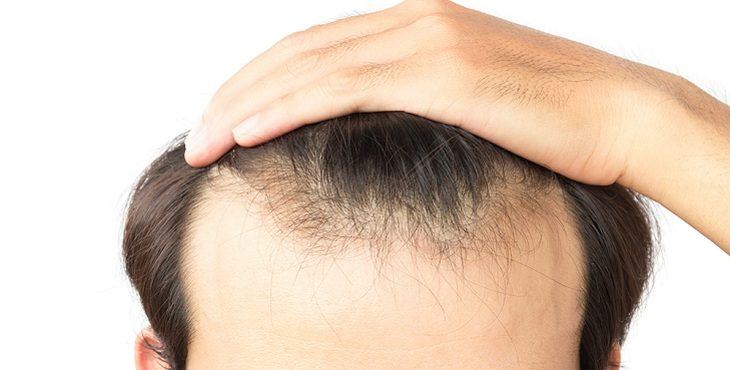 تكلفة عملية زراعة الشعر , تكلفة زراعة الشعر في مصر