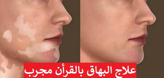 علاج البهاق بالقران , فى علاج روحانى للبهاق