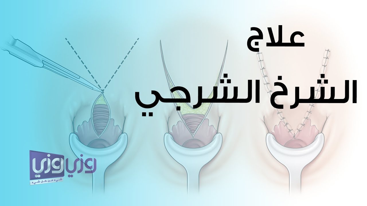 علاج الشرخ الشرجي بدون كريمات وعمليات جراحيه , التخلص من الم الشرج