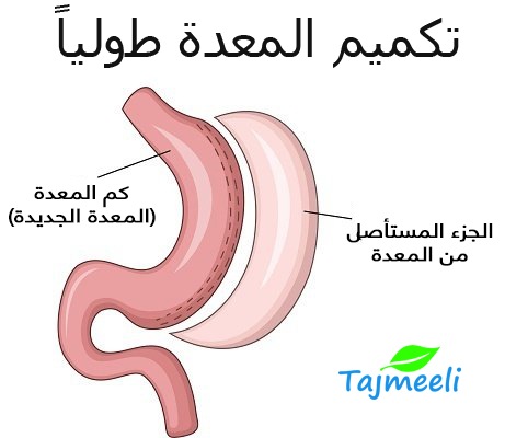 ما هي عملية تكميم المعدة , عايزة تخسي تعالي اقولك معلومات عن العملية دي