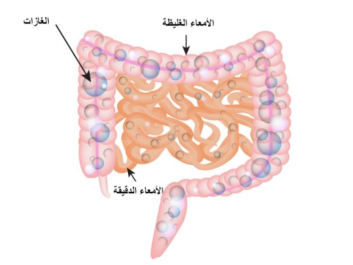 اعراض غازات القولون , انا اعاني من القولون العصبي